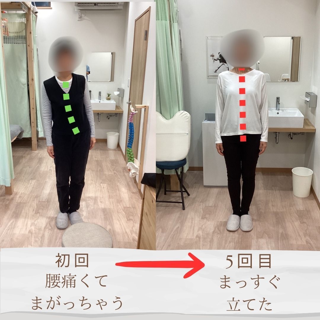 「施術前の姿勢ゆがみ測定　猫背・反り腰の歪みが見られる上福岡みつばち美容整骨院ビフォー写真」