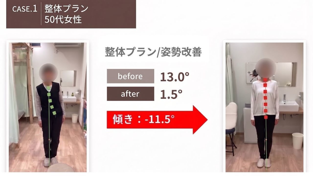 「施術前の姿勢ゆがみ測定　猫背・反り腰の歪みが見られる上福岡みつばち美容整骨院ビフォー写真」