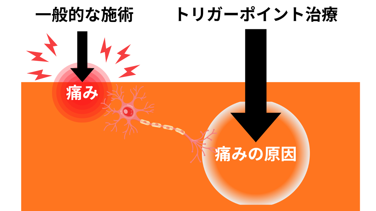 深層筋リリースによる本格手技施術風景　ふじみ野市上福岡　美容整骨院