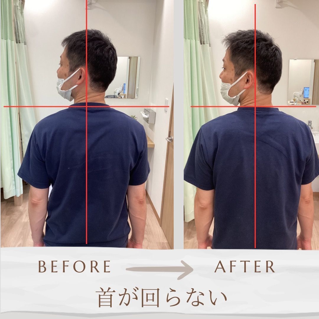 「深層筋リリースと骨盤矯正で姿勢改善した施術後のアフター姿勢　上福岡みつばち美容整骨院」